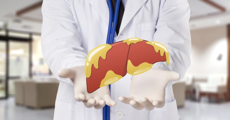 A csendes májbetegség, amely a túlsúly és a cukorbetegség következtében alakulhat ki, komoly figyelmet érdemel. Az MASLD (metabolikus szindróma által kiváltott zsírmáj betegség) időbeni felismerése kulcsfontosságú a megelőzés és a kezelés szempontjából. Í